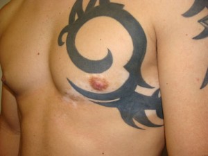 Nipple Reduction Before and After 15 | Grover Aesthetics