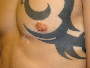 Nipple Reduction Before and After 15 | Grover Aesthetics