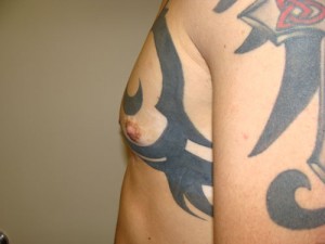 Nipple Reduction Before and After 15 | Grover Aesthetics