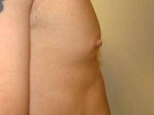Nipple Reduction Before and After 15 | Grover Aesthetics