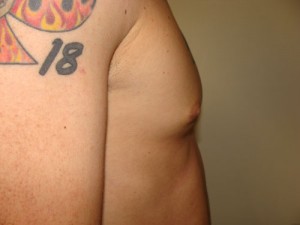 Nipple Reduction Before and After 15 | Grover Aesthetics