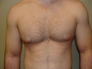 Nipple Reduction Before and After | Grover Aesthetics