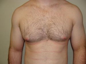 Nipple Reduction Before and After | Grover Aesthetics