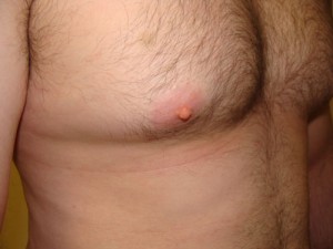 Nipple Reduction Before and After 16 | Grover Aesthetics