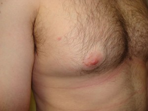 Nipple Reduction Before and After 16 | Grover Aesthetics