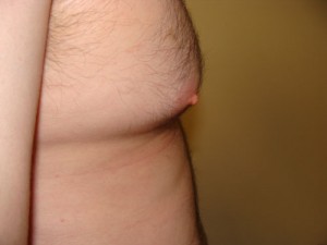Nipple Reduction Before and After 16 | Grover Aesthetics