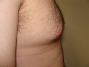 Nipple Reduction Before and After 16 | Grover Aesthetics