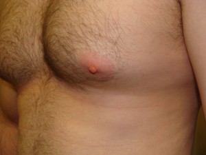 Nipple Reduction Before and After 16 | Grover Aesthetics
