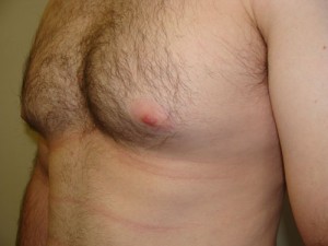 Nipple Reduction Before and After 16 | Grover Aesthetics