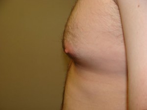 Nipple Reduction Before and After 16 | Grover Aesthetics