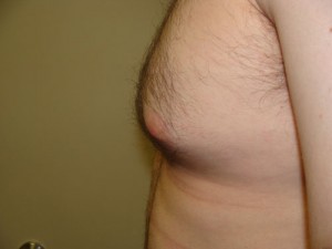 Nipple Reduction Before and After 16 | Grover Aesthetics