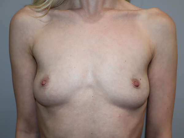 Preservé By Motiva Before and After | Grover Aesthetics