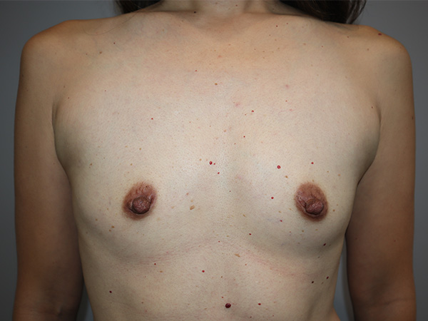 Preservé By Motiva Before and After | Grover Aesthetics