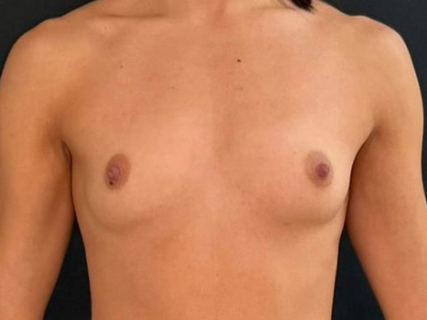 Preservé By Motiva Before and After | Grover Aesthetics