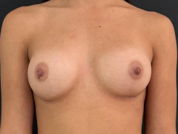 Preservé By Motiva Before and After | Grover Aesthetics