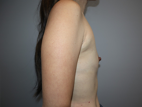 Preservé By Motiva Before and After 10 | Grover Aesthetics