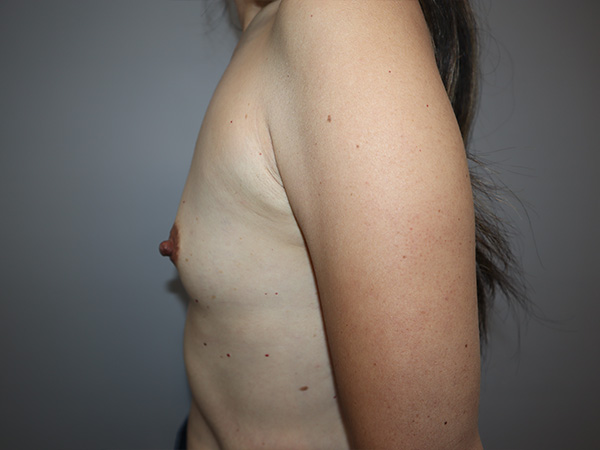Preservé By Motiva Before and After 10 | Grover Aesthetics