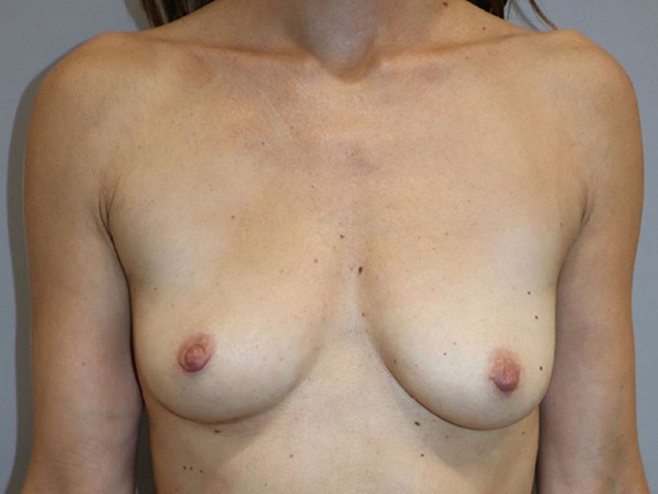 Preservé By Motiva Before and After | Grover Aesthetics