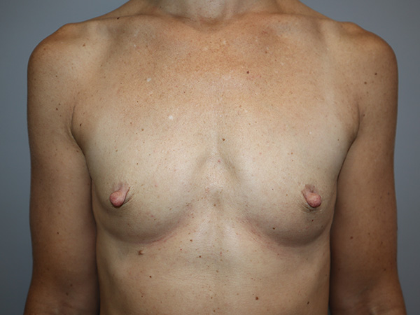 Preservé By Motiva Before and After | Grover Aesthetics