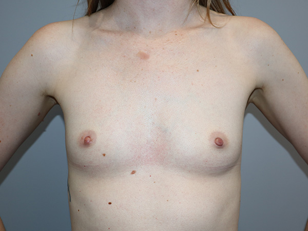 Preservé By Motiva Before and After | Grover Aesthetics