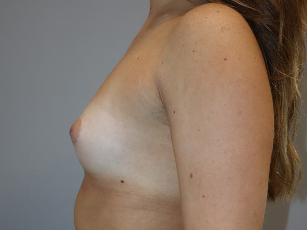 Preservé By Motiva Before and After 25 | Grover Aesthetics
