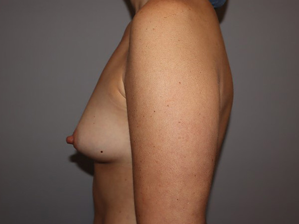 Preservé By Motiva Before and After 29 | Grover Aesthetics