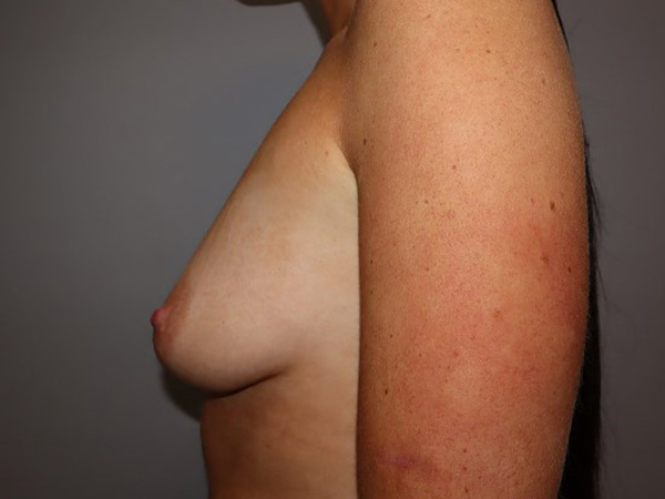 Preservé By Motiva Before and After 30 | Grover Aesthetics