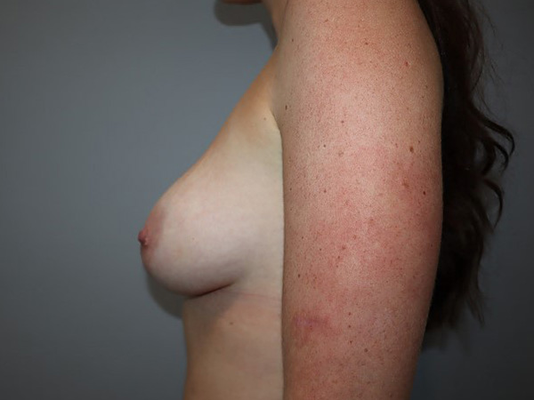 Preservé By Motiva Before and After 30 | Grover Aesthetics