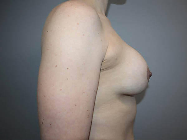 Preservé By Motiva Before and After 31 | Grover Aesthetics