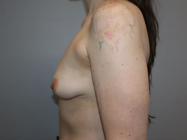 Preservé By Motiva Before and After 31 | Grover Aesthetics