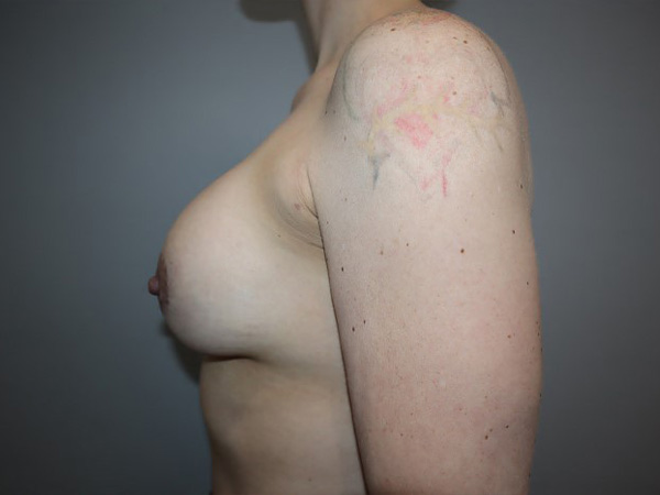 Preservé By Motiva Before and After 31 | Grover Aesthetics