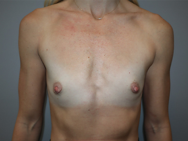 Preservé By Motiva Before and After | Grover Aesthetics
