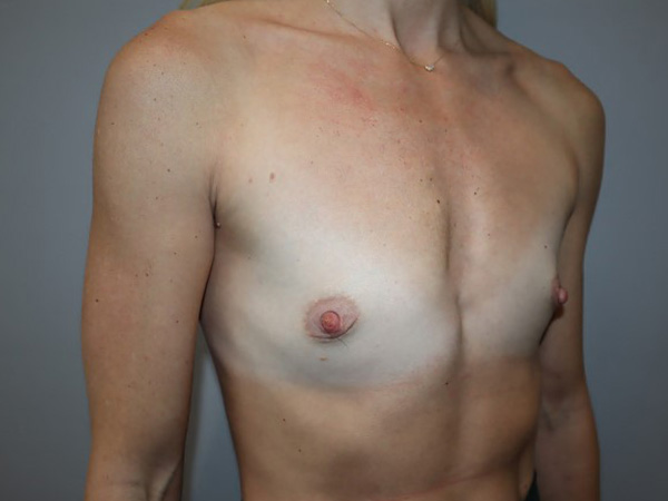Preservé By Motiva Before and After 33 | Grover Aesthetics