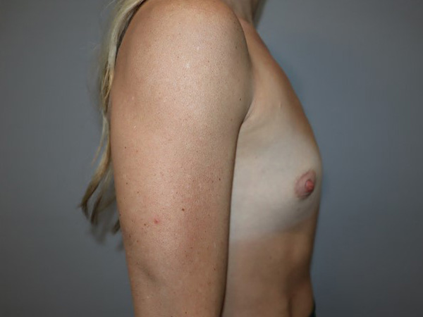 Preservé By Motiva Before and After 33 | Grover Aesthetics