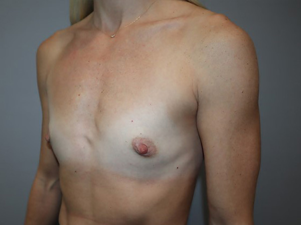 Preservé By Motiva Before and After 33 | Grover Aesthetics