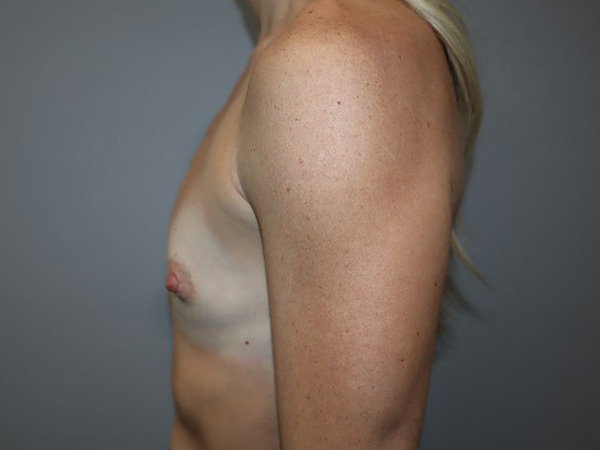 Preservé By Motiva Before and After 33 | Grover Aesthetics