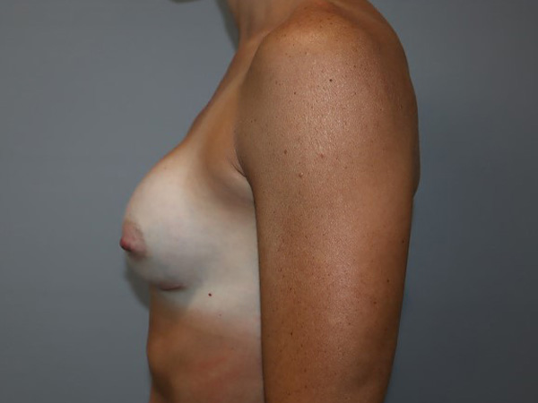 Preservé By Motiva Before and After 33 | Grover Aesthetics