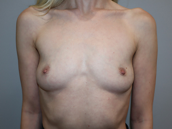 Preservé By Motiva Before and After | Grover Aesthetics