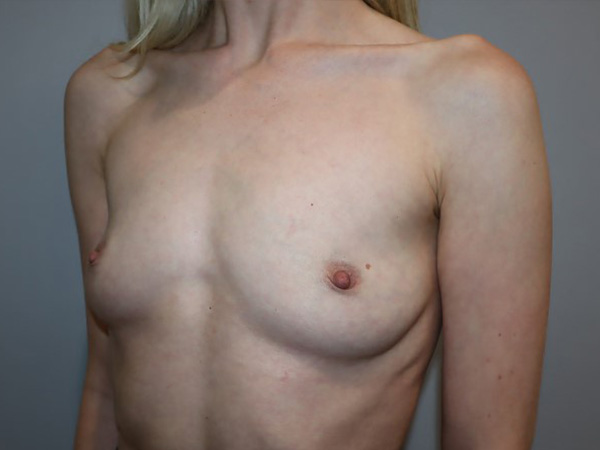 Preservé By Motiva Before and After 34 | Grover Aesthetics