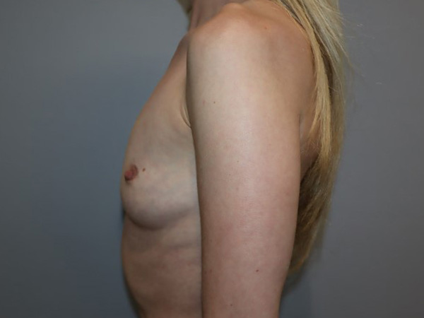 Preservé By Motiva Before and After 34 | Grover Aesthetics