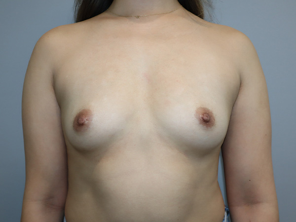 Preservé By Motiva Before and After | Grover Aesthetics