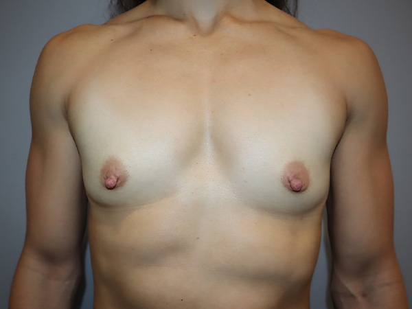 Preservé By Motiva Before and After | Grover Aesthetics