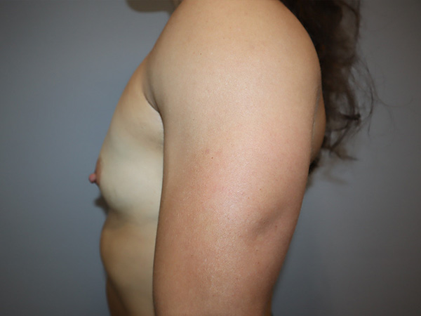 Preservé By Motiva Before and After 40 | Grover Aesthetics