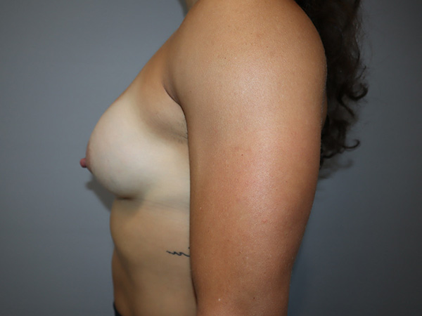 Preservé By Motiva Before and After 40 | Grover Aesthetics