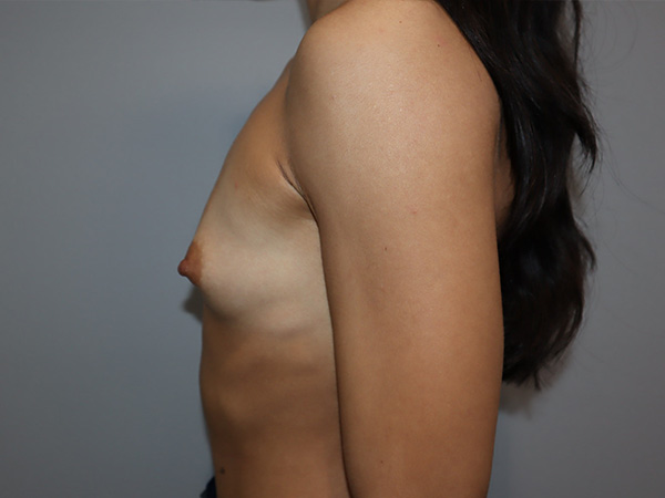 Preservé By Motiva Before and After 42 | Grover Aesthetics