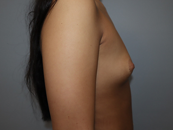 Preservé By Motiva Before and After 43 | Grover Aesthetics