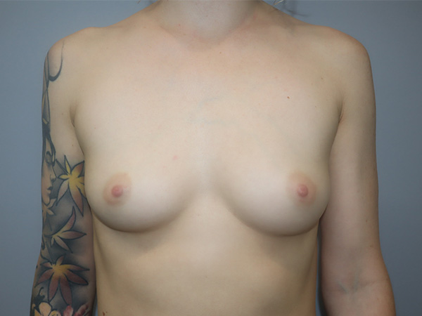 Preservé By Motiva Before and After | Grover Aesthetics
