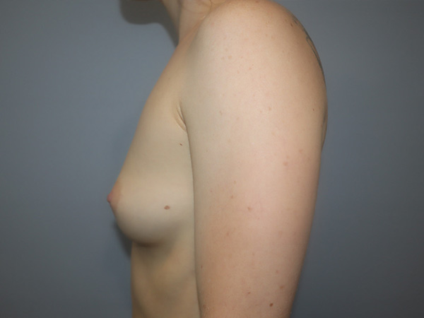 Preservé By Motiva Before and After 44 | Grover Aesthetics