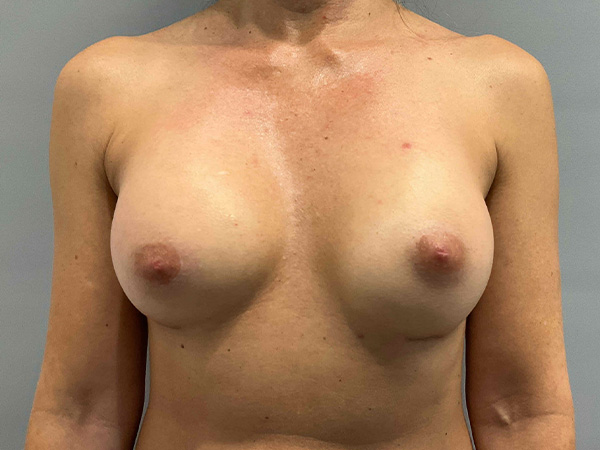 Preservé By Motiva Before and After | Grover Aesthetics