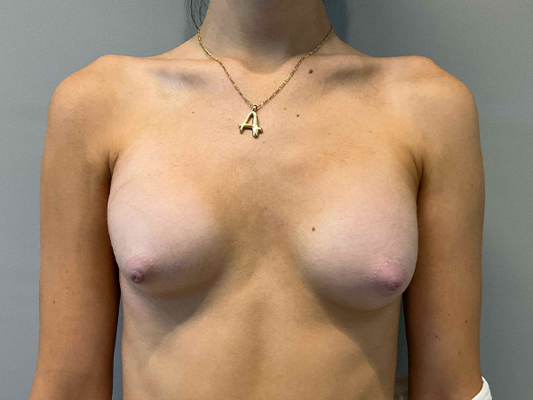 Preservé By Motiva Before and After | Grover Aesthetics
